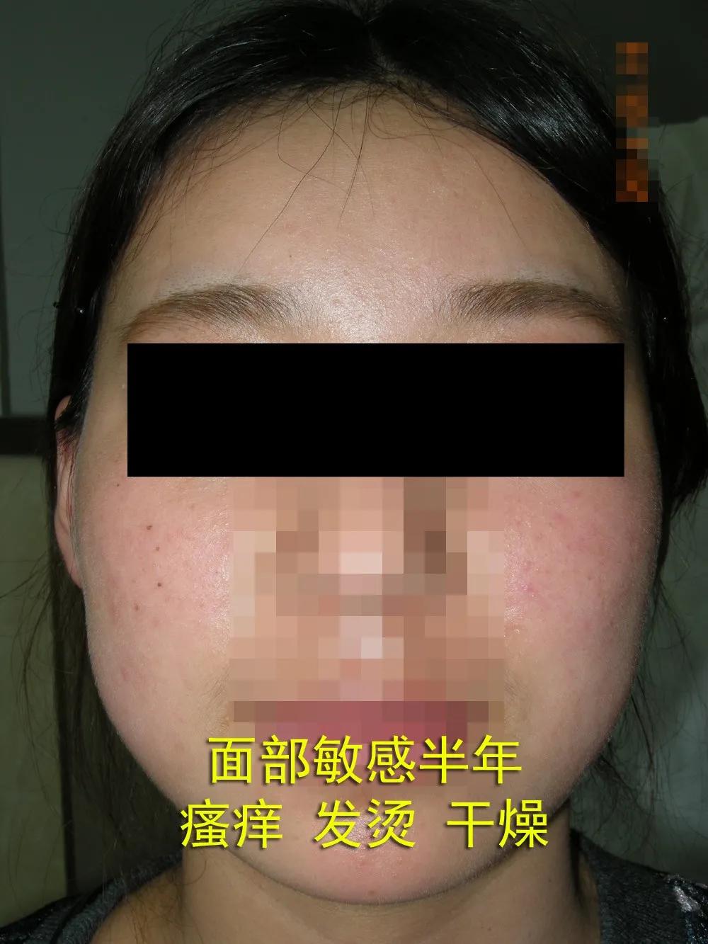 护肤一定要坚持且要有耐心,激素依赖性皮炎怎么护肤