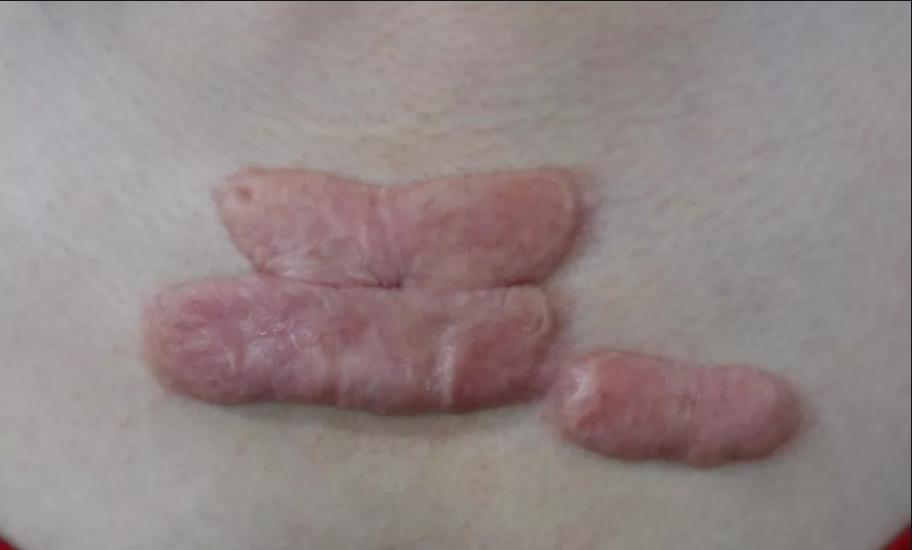 疤痕增生刺痛怎么缓解,为什么按疤痕会有刺痛