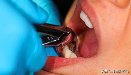拔完智齿吃东西有什么需要注意的,横向阻生智齿有什么忌口