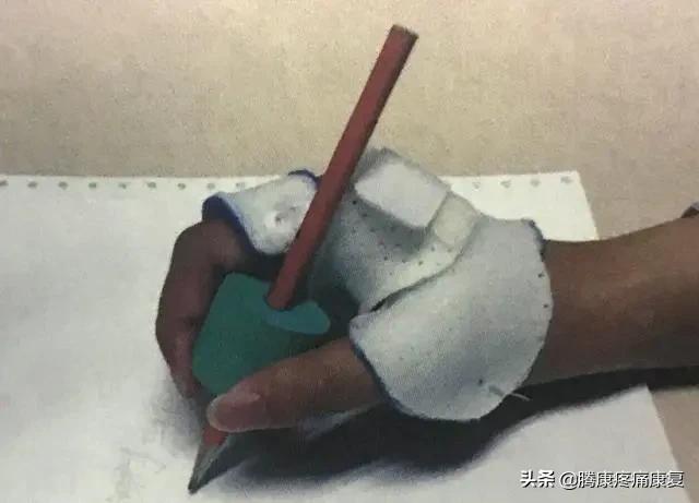 正中神经损伤治疗方法,正中神经损伤康复训练