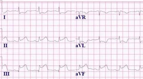 常见心梗特殊心电图,各部位心梗心电图详解