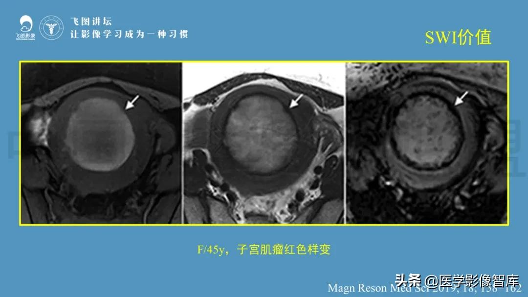 子宫解剖结构输卵管和卵巢位置,子宫附件ct影像学正常解剖表现