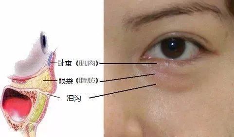 轻医美干细胞填充泪沟真实案例,泪沟明显怎么做医美