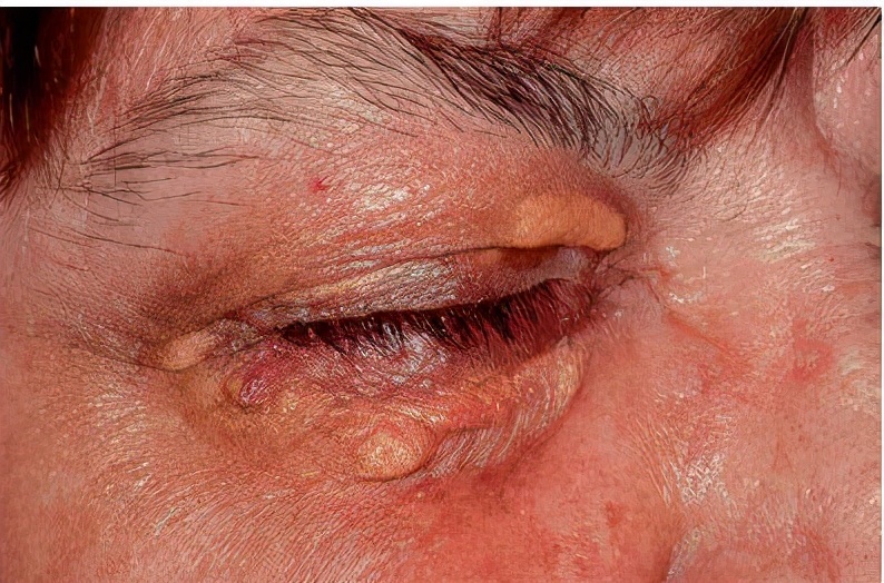 脸上长了闭口小颗粒怎么去除,脸上长白色小颗粒怎样去除掉