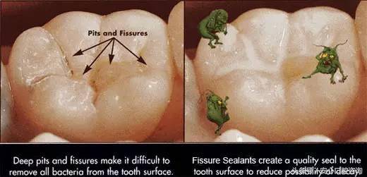 孩子长龋齿蛀牙怎么办,2岁半宝宝龋齿蛀牙严重怎么补救