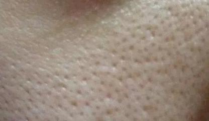 脸上的痘痘怎么解决干货,彻底根治脸上痘痘的干货