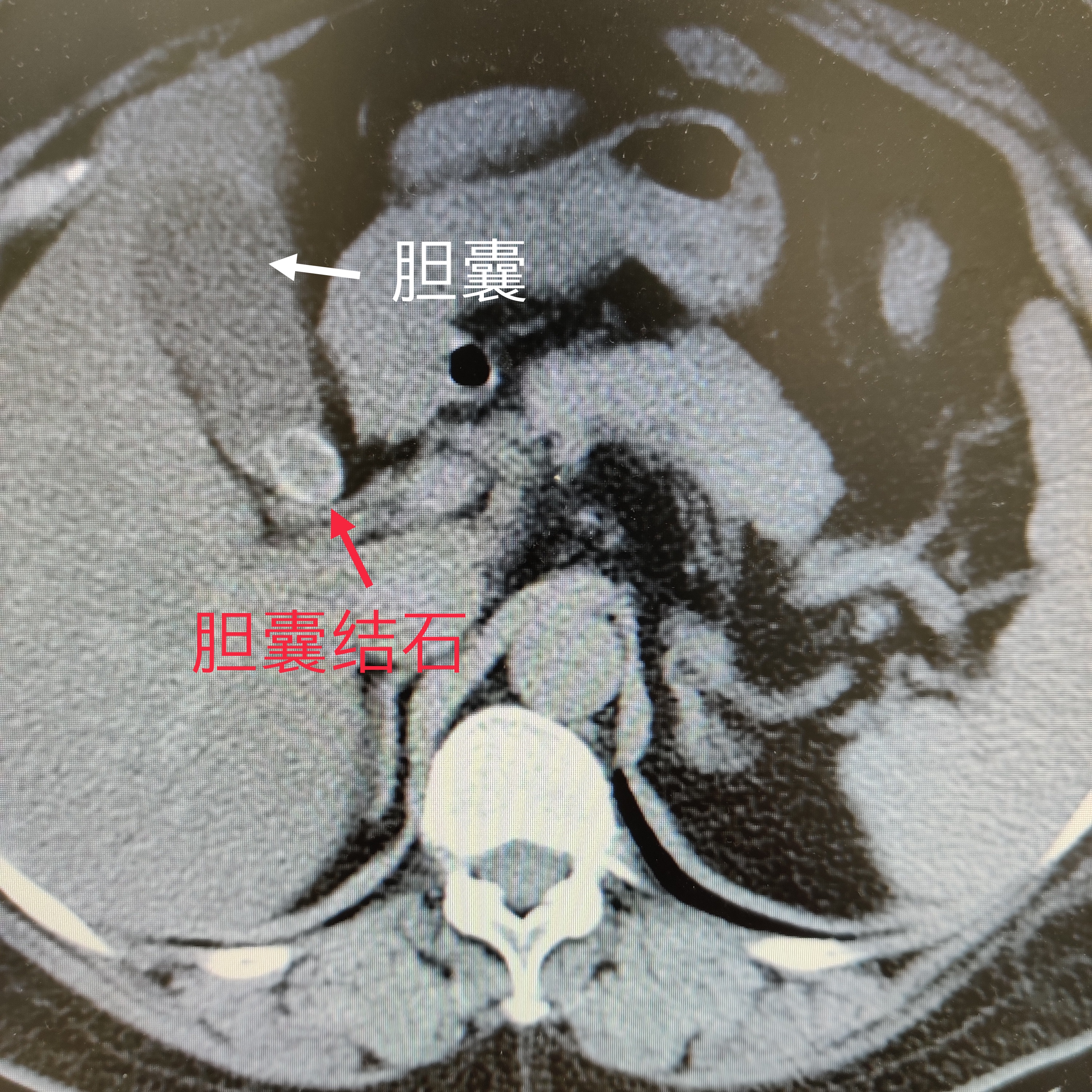 找不到原因的右上腹痛,胃部有石头是什么原因