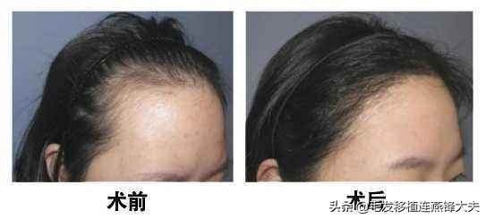 女性脱发是什么原因呢,女性睾酮低脱发怎么办