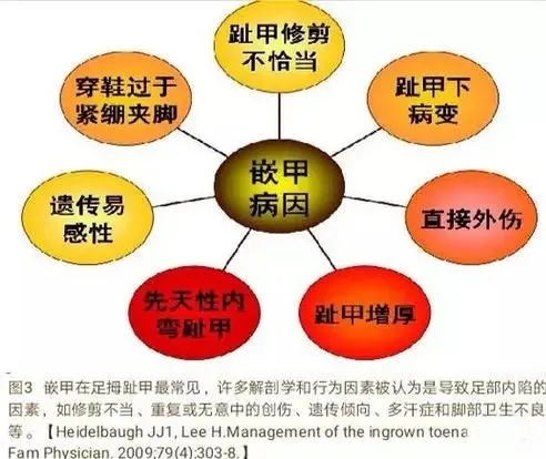 指甲老往肉里长化脓,指甲为什么一直往肉里长