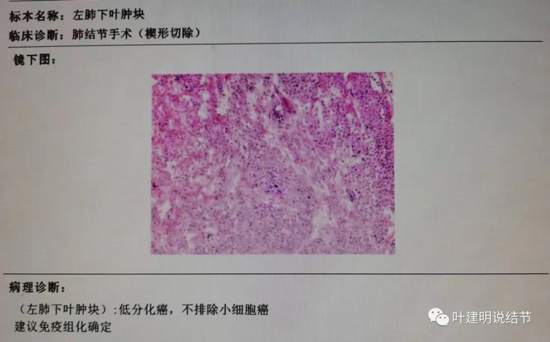 肺上有实性结节6mmx5mm是什么原因,肺上有1.7x1.8的实性结节该怎么办