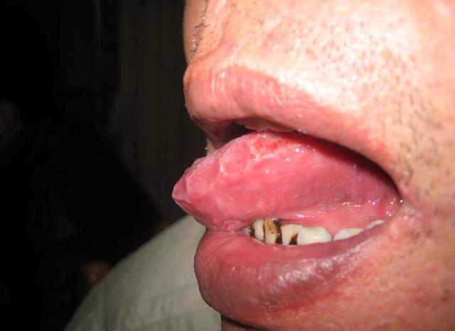口腔溃疡老发作需警惕自身免疫病,口腔溃疡反复发作要警惕什么癌
