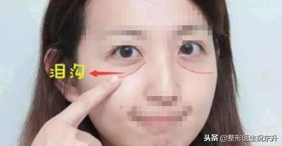 鼻唇沟泪沟法令纹,18岁有眼沟纹和法令纹怎么办