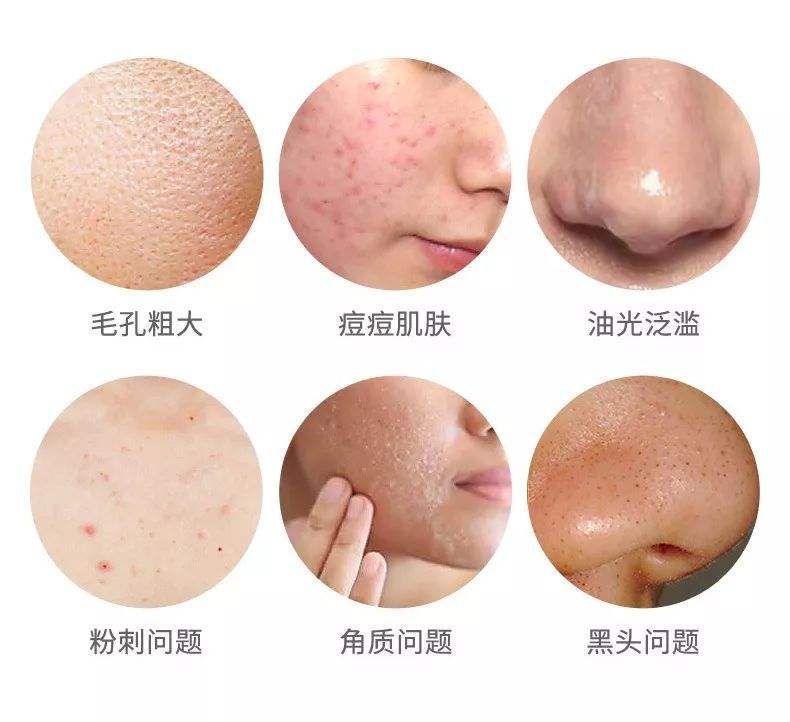 螨虫脸用什么解决,螨虫的克星植物是什么