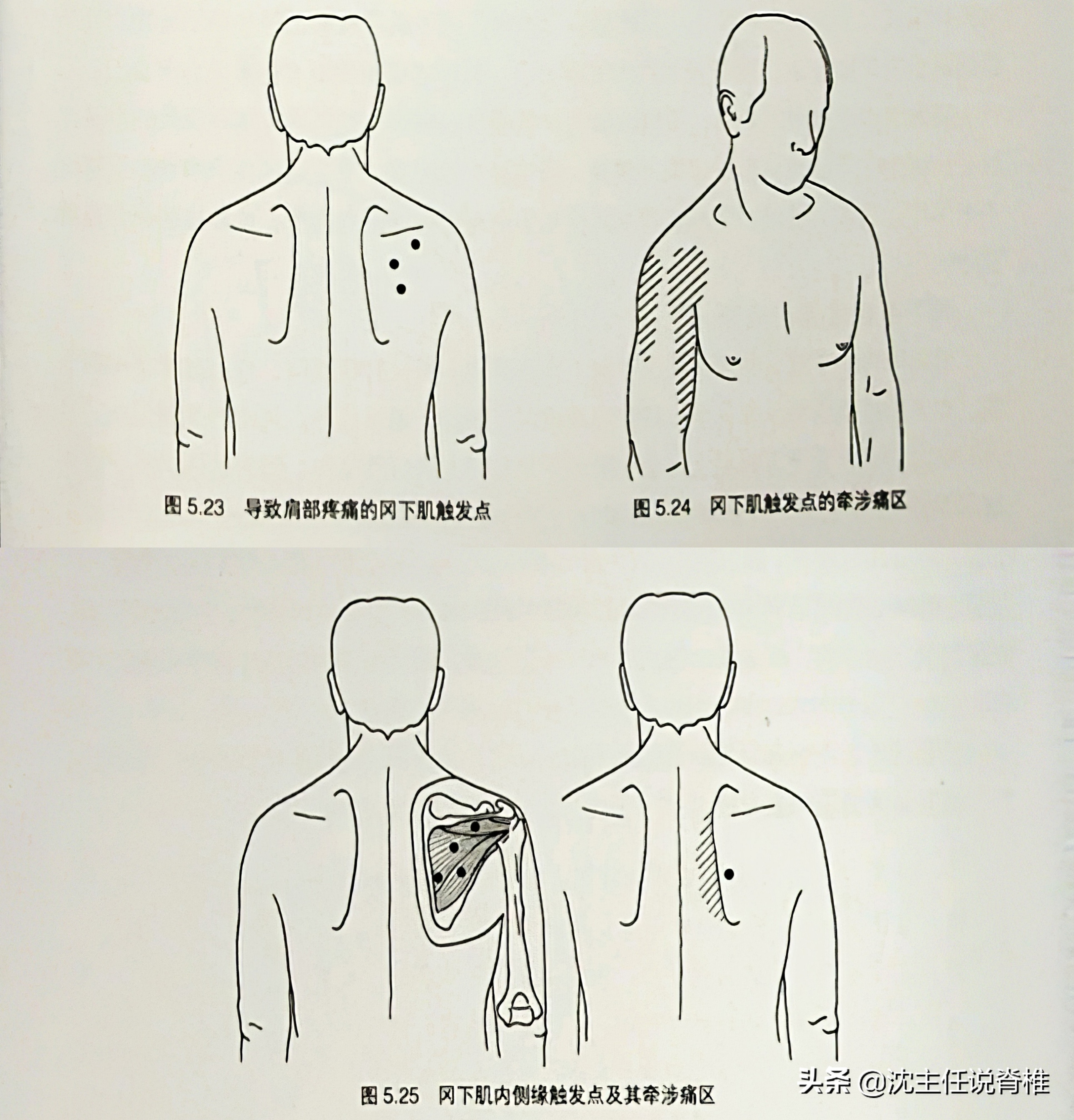 手麻是颈椎引起的吗吃什么药,颈椎病引起头胀痛的症状