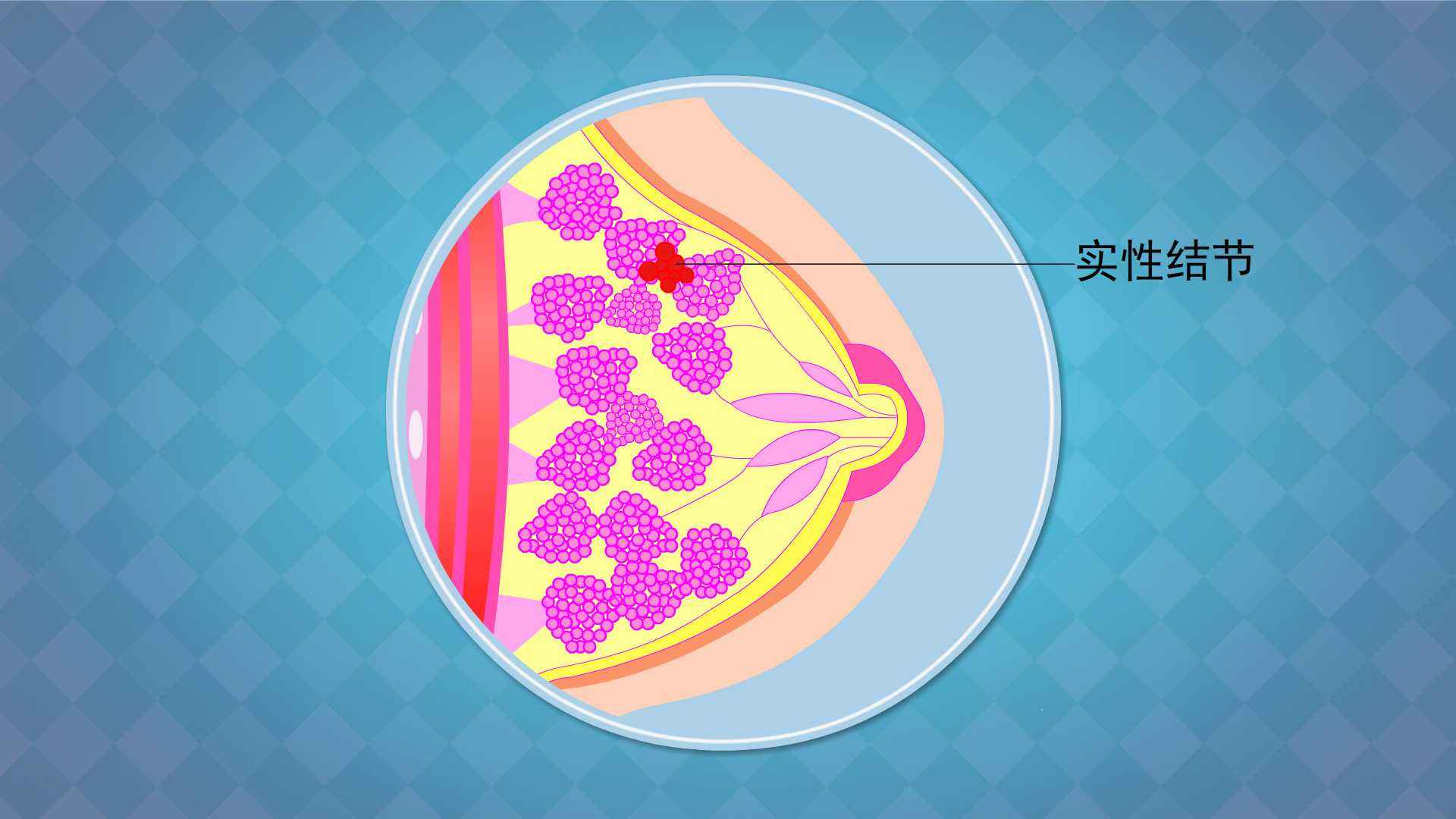 乳房体检有结节普遍吗,乳房结节自我诊断