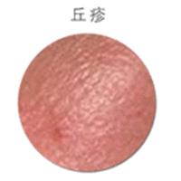 痘痘中医怎么解释,痘痘中医