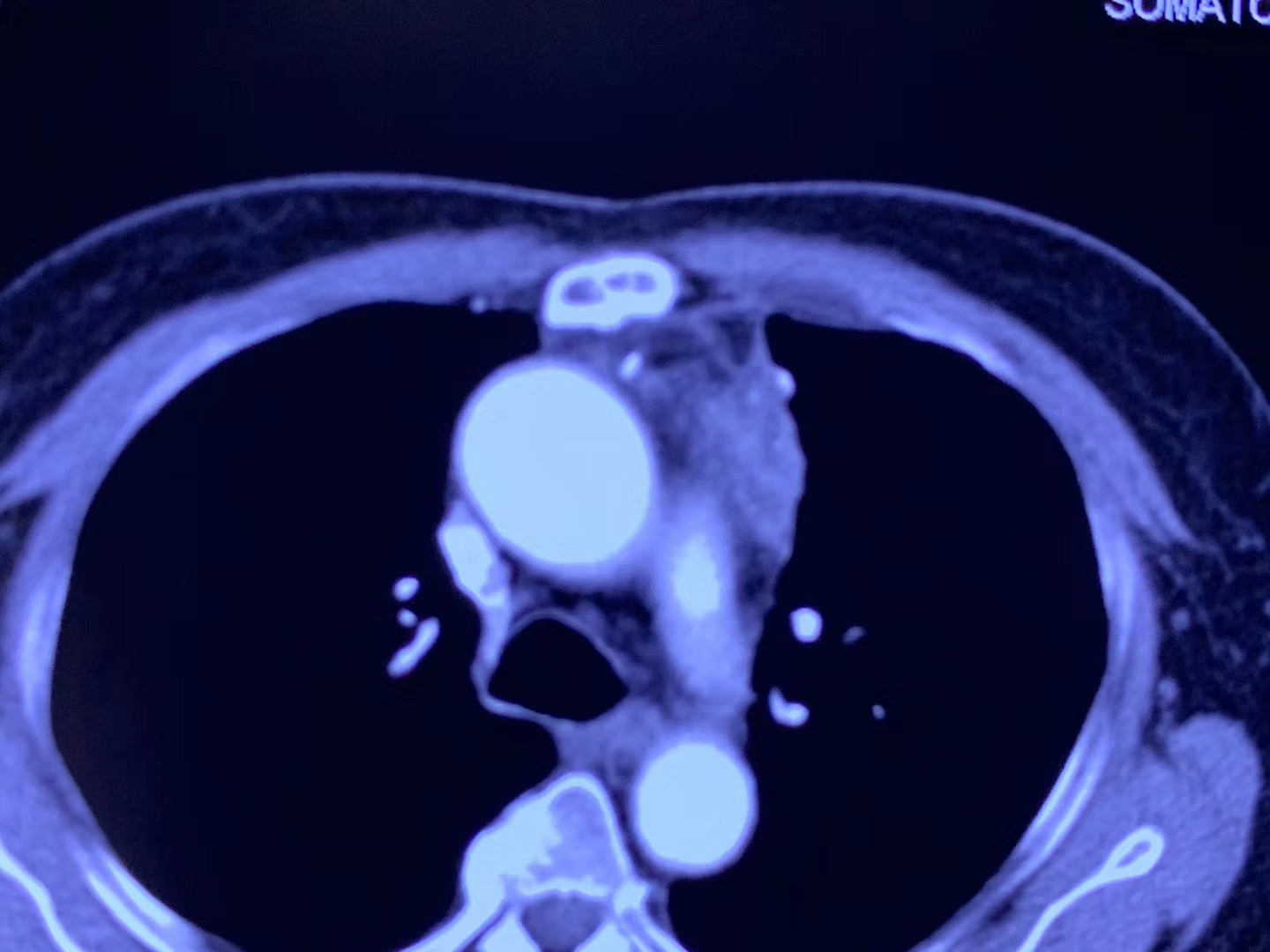 胸腺肿瘤不能手术该怎么治疗,胸腺瘤微波消融