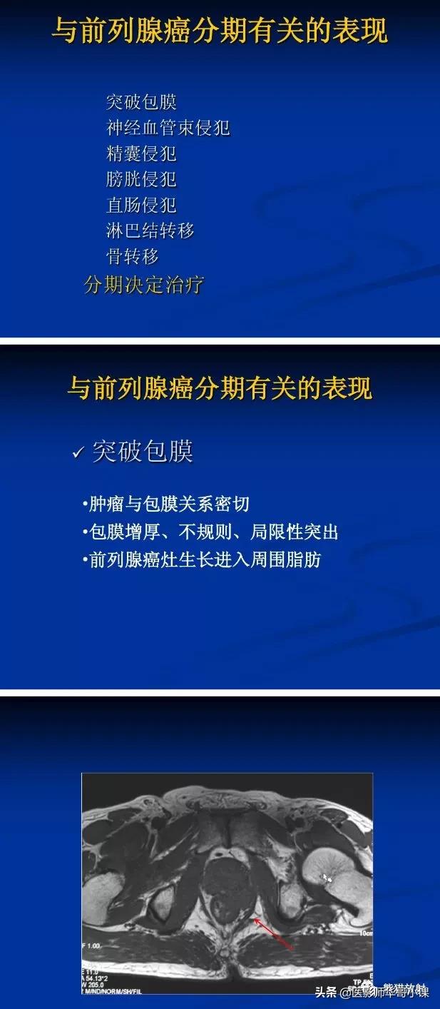 前列腺磁共振影像解剖,前列腺mri正常诊断报告模板
