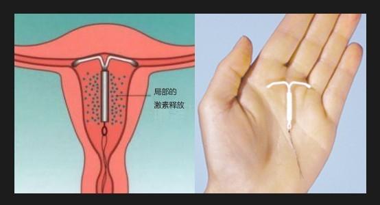 绝经后子宫全切的危害,子宫切除后节育环还在体内吗