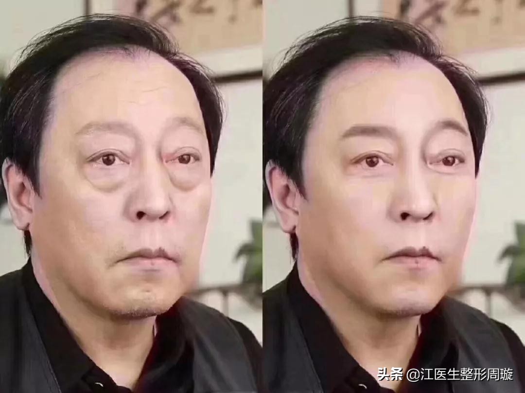 如何快速去除眼袋有效方法,如何快速去除眼袋和黑眼圈