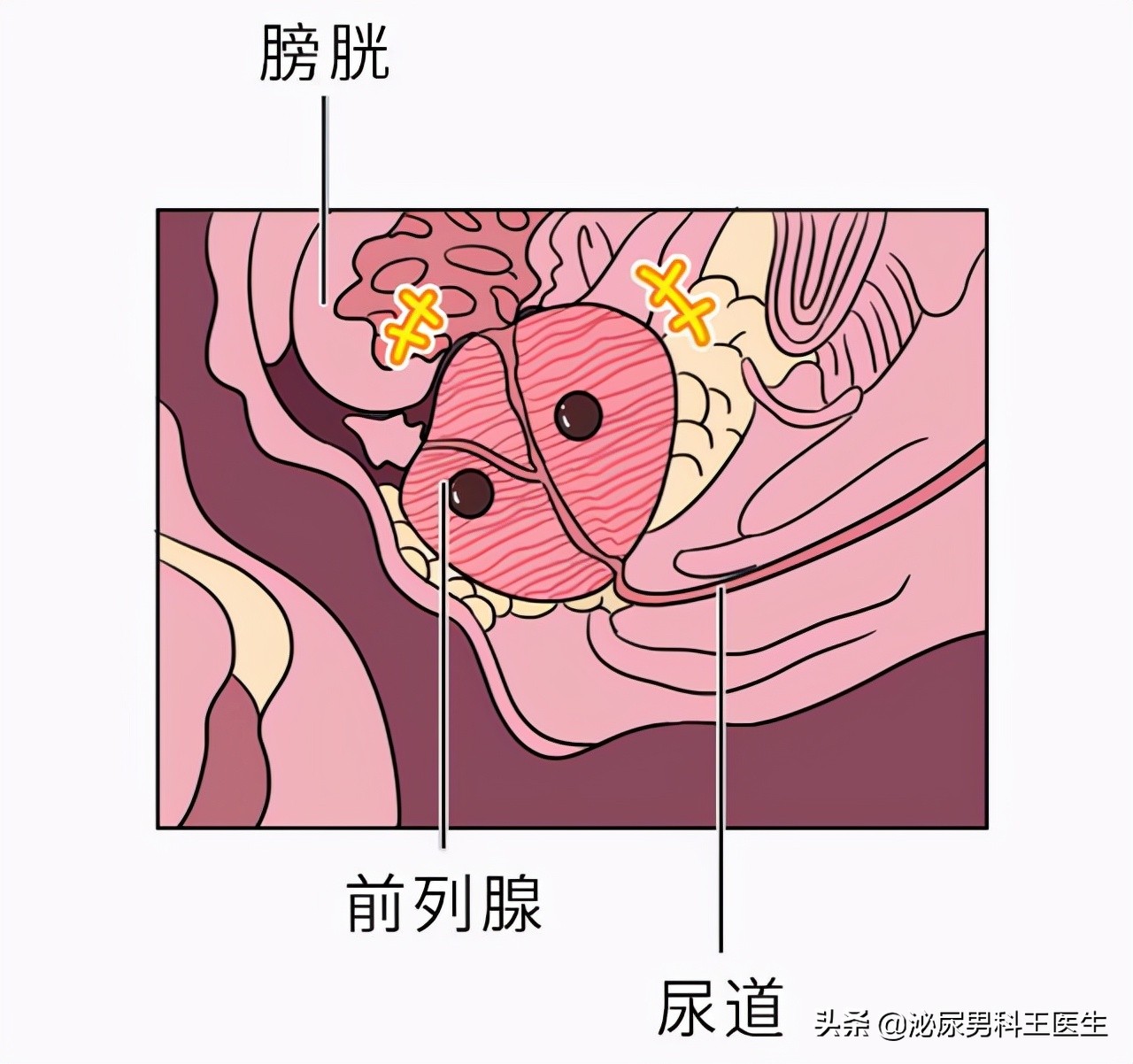 25岁前列腺增生是什么原因引起的,前列腺增生多久做一次psa检查好