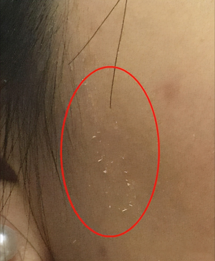 如何有效的去角质,去角质方法长期不去角质会怎样