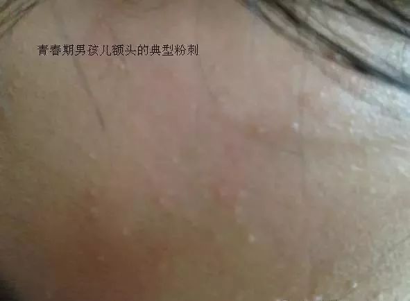 祛除闭合性粉刺软膏有哪些,下巴有闭合性粉刺怎么祛除