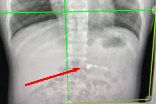 一岁小孩吞无线耳机,男孩误吞无线耳机