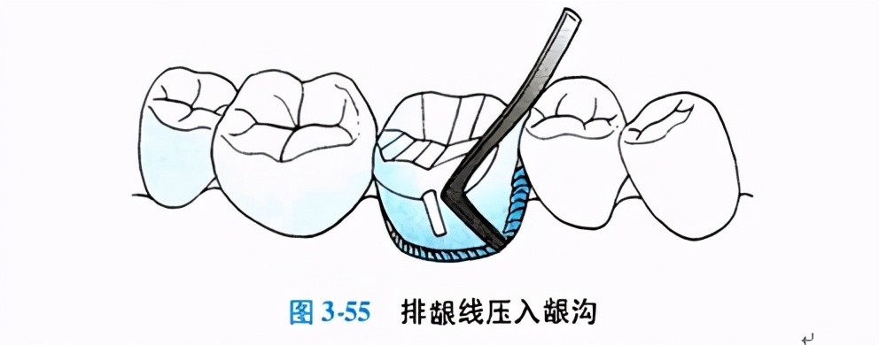口腔金属冠与全瓷冠的区别,牙科医生讲义