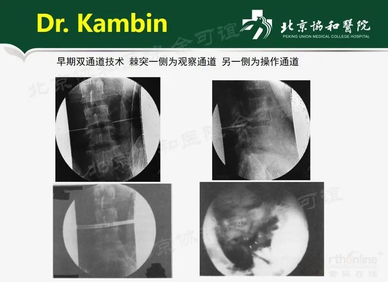 单侧双通道脊柱内镜技术优势,双通道脊柱内镜