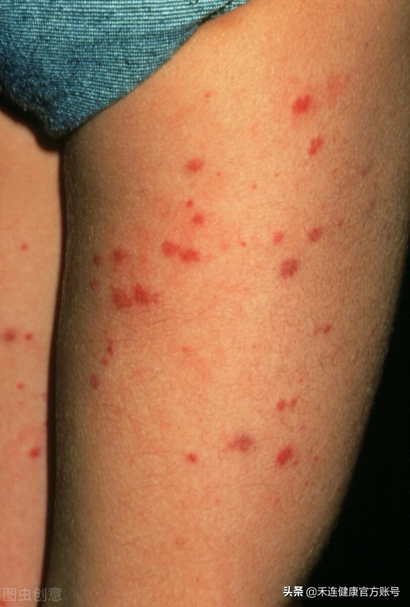 身上出现小红点是肝出现问题了吗,身上有小红点跟肝有关系吗