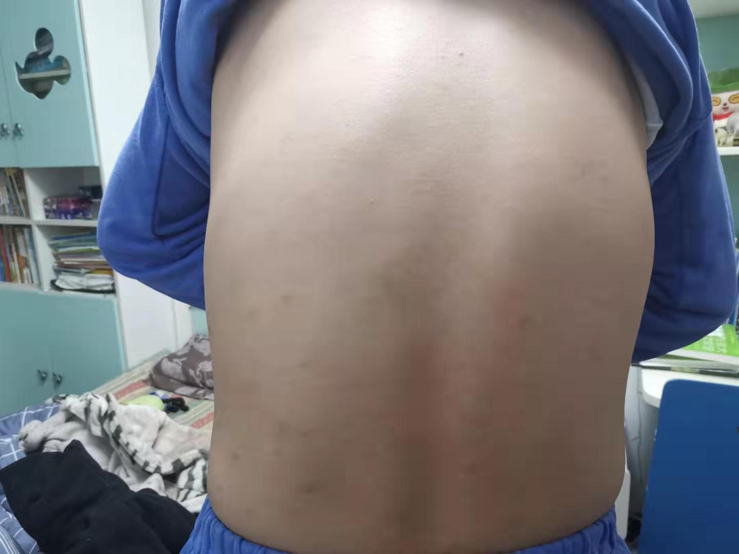 中医治疗皮肤痒的最好方法,中医治疗皮肤纤维瘤