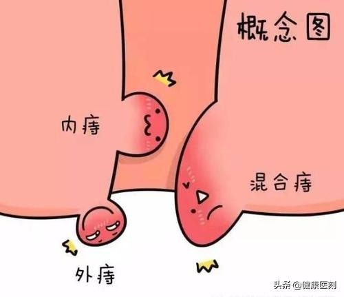 痔疮排便后都有什么症状,有痔疮排便困难的快速解决方法