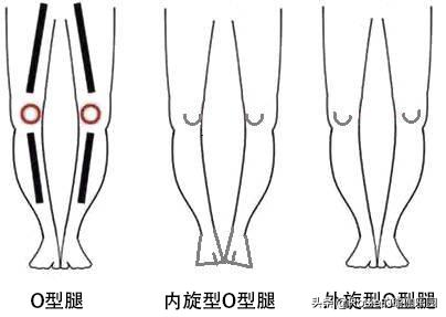 大腿根缝隙大o型腿怎么矫正,穿软鞋子造成o型腿怎么矫正