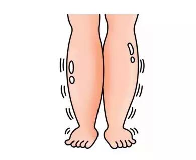 航天健康大讲堂——下肢水肿怎么办？