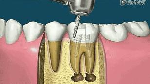 大连口腔视频,大连市口腔医院根管治疗