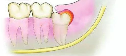 牙龈肿痛吃药不好,上火引起牙龈肿痛十大消炎药