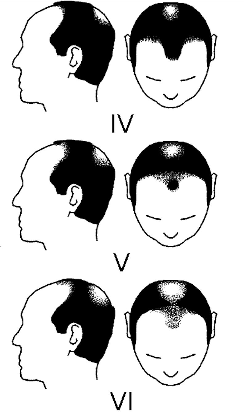 人到中年不得已都开始秃顶了,中年男人的三大危机秃顶发福