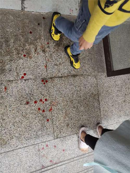 压面机咬手嘉祥消防巧妙施救,压面机咬男子手