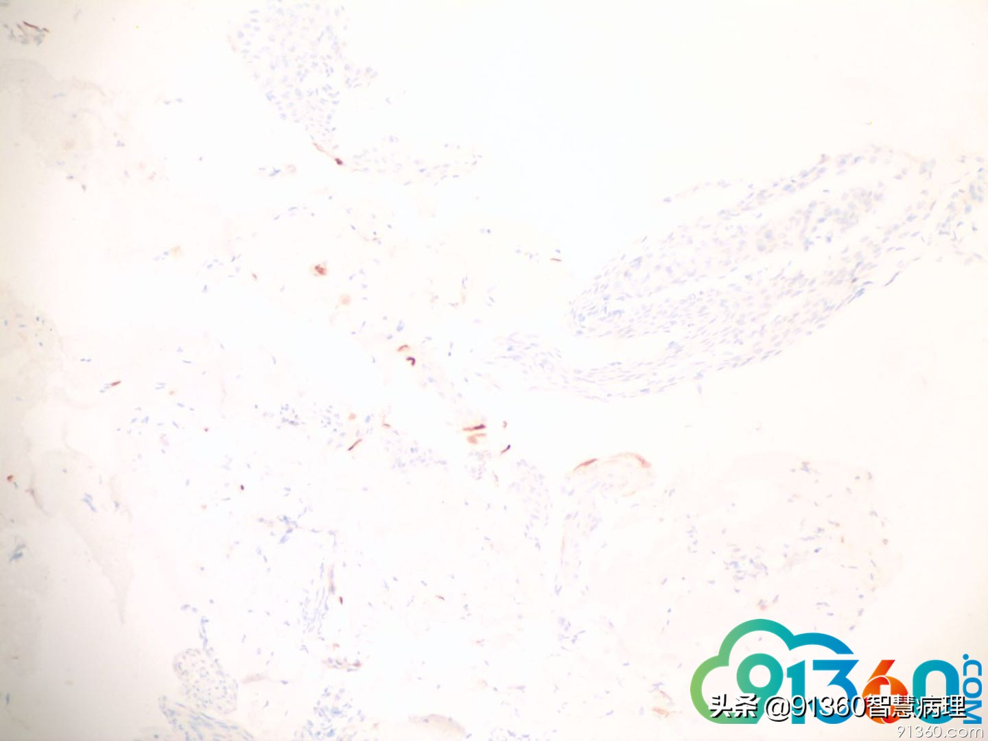 宫颈病理tct是什么检查,tct出现ascus会是宫颈癌吗