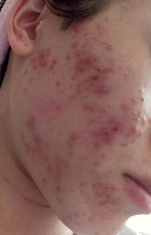 皮肤为什么会长痘长斑,皮肤为啥会长斑