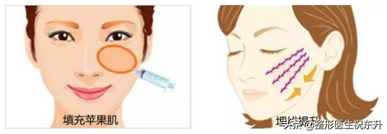 法令纹松弛脸颊下垂怎么填充,用什么来填充法令纹是最好的