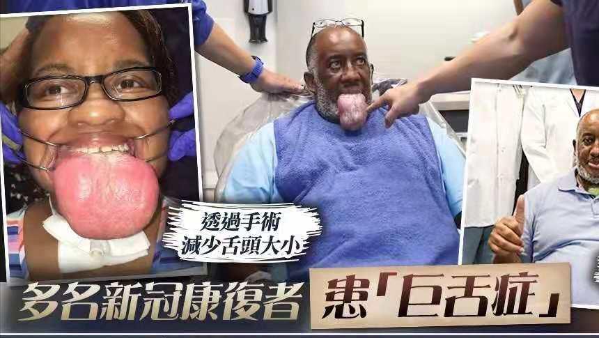 新冠痊愈巨舌症,美国新冠后遗症患者自述巨舌症