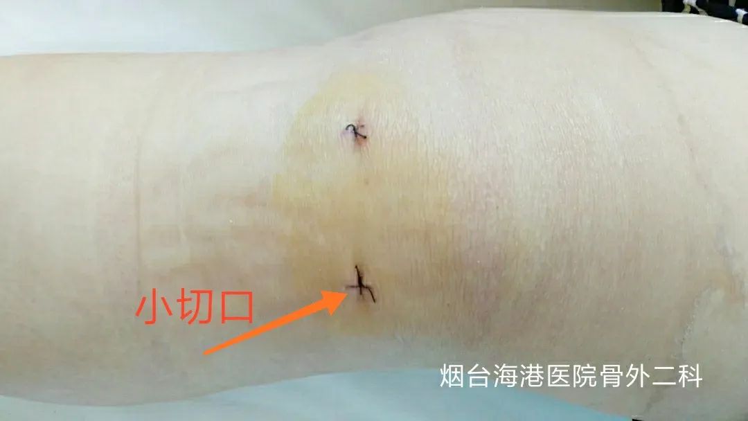 膝关节半月板损伤2-3度手术,半月板关节镜微创手术恢复状况