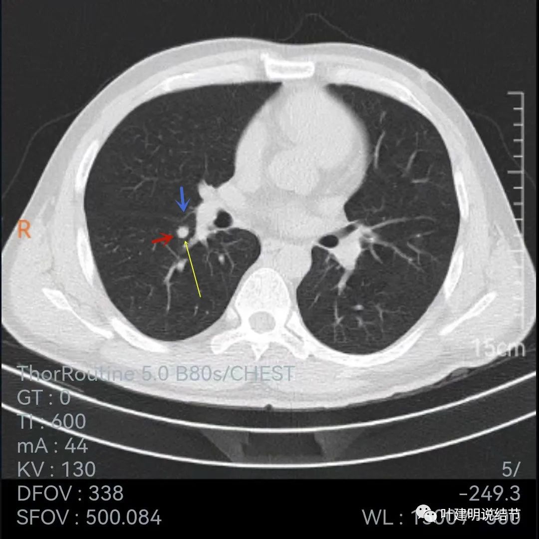 问诊分析：存在了4年的实性结节会不会是肺癌？