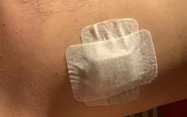 小心！理发的头发碴扎进皮肤，他倒在手术台上