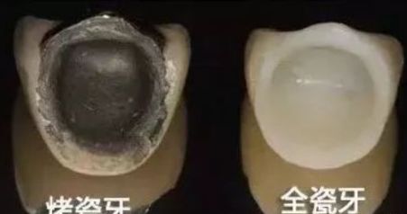 二氧化锆牙齿能做ct和核磁共振吗,氧化锆全锆牙冠能做核磁共振吗