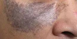 各种面部斑图片,如何辨别脸上的斑