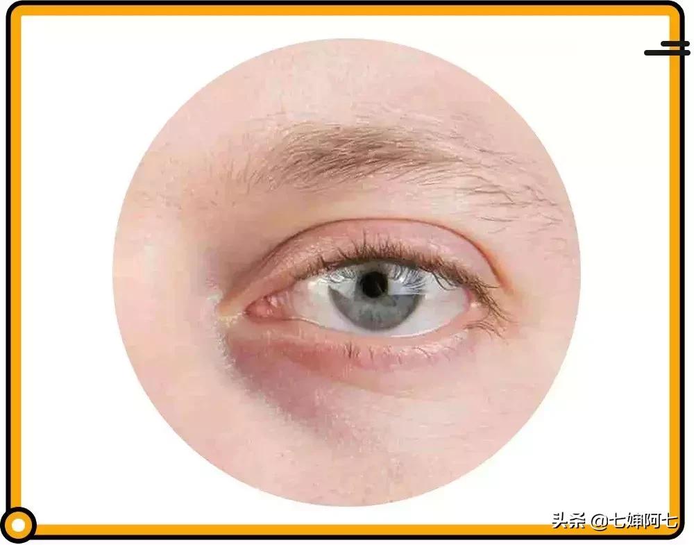 长久都无法消除的黑眼圈,顽固性的黑眼圈要怎么去