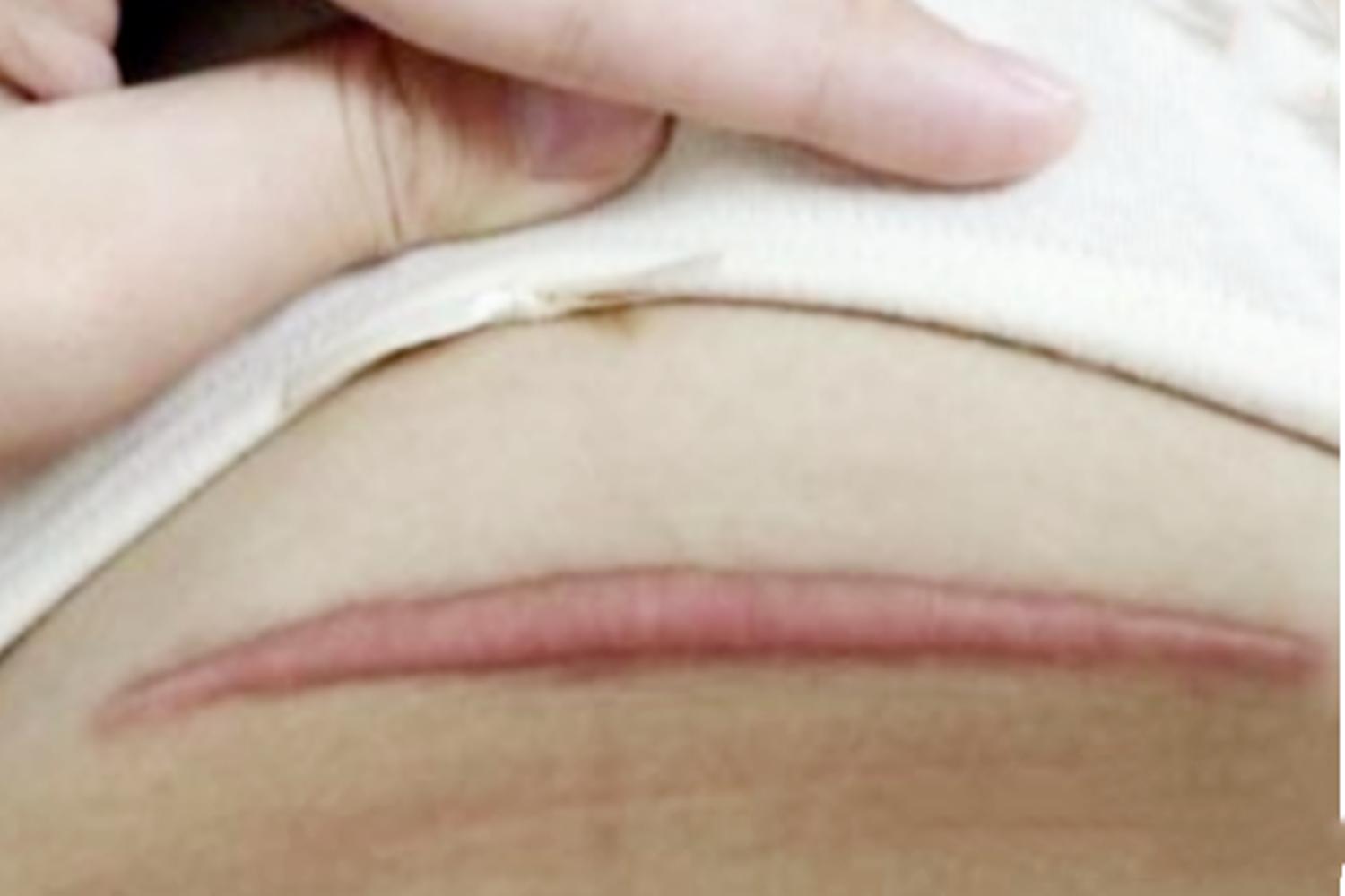 剖腹产后十年了刀口痒用什么擦,剖腹产第32天刀口痒浑身酸疼